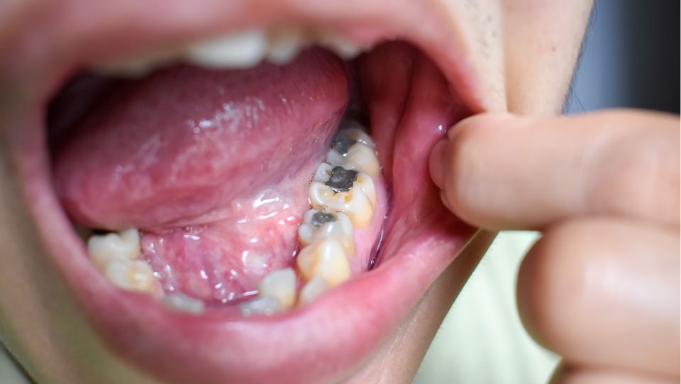 Amalgam removal at SHDC using the SMART protocol