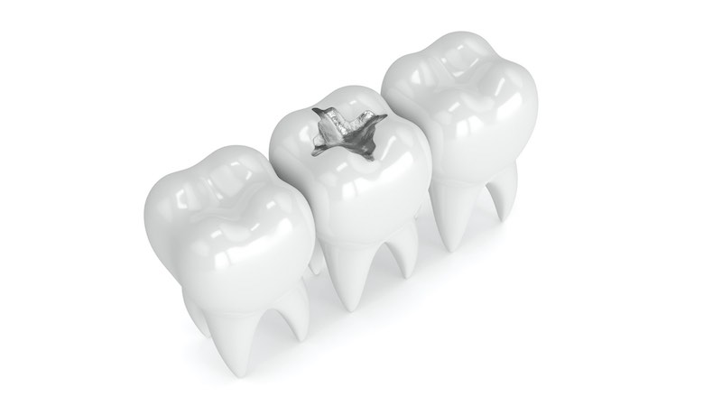 amalgam removal