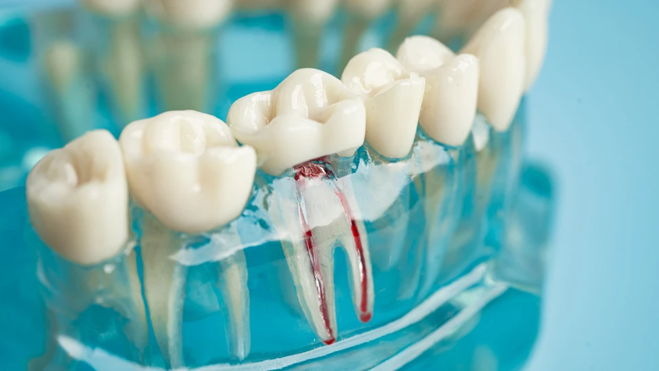 Root Canal Treatment