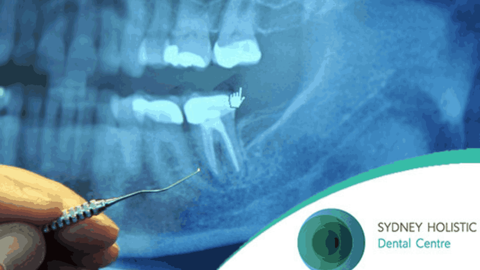 wisdom teeth
