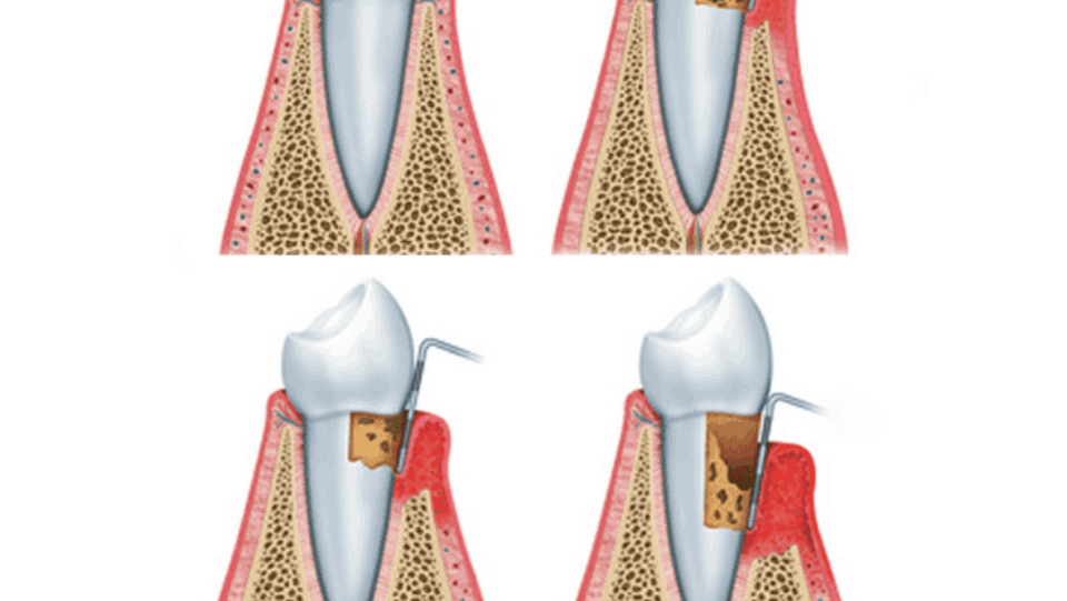 gum disease