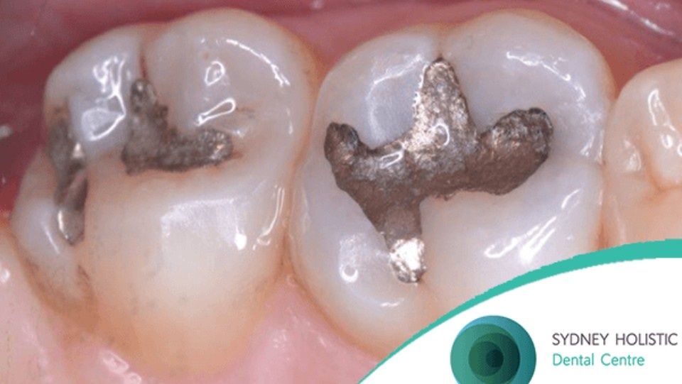 mercury amalgam