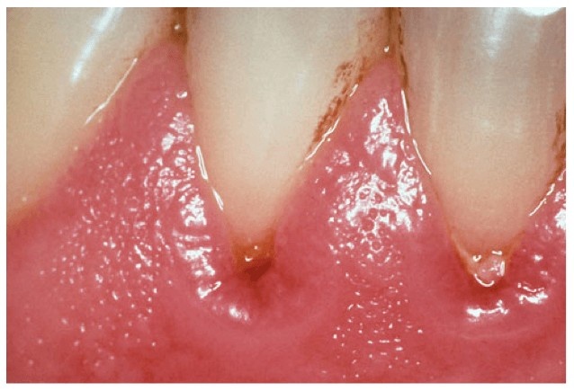 Gum disease treatment